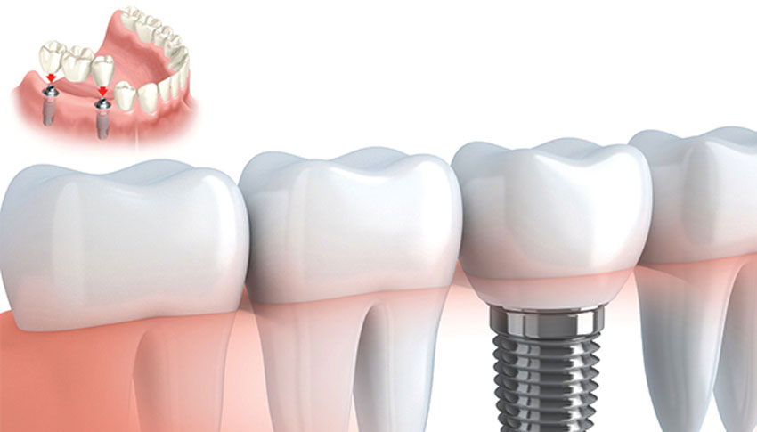 Dental Implants Crown & Bridges